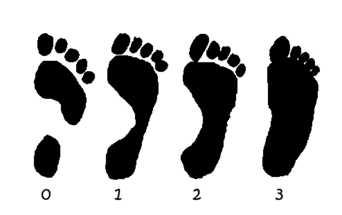https://upload.wikimedia.org/wikipedia/commons/thumb/2/27/Flatfeet.jpg/250px-Flatfeet.jpg